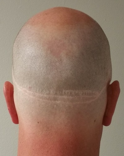 Scalp Micropigmentation | SMP Hair Tattoo for Scar
