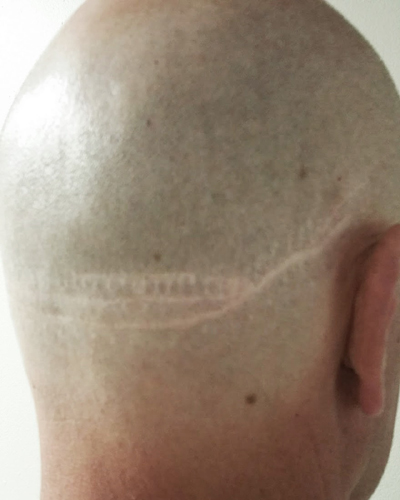 Scalp Micropigmentation | SMP Hair Tattoo for Scar