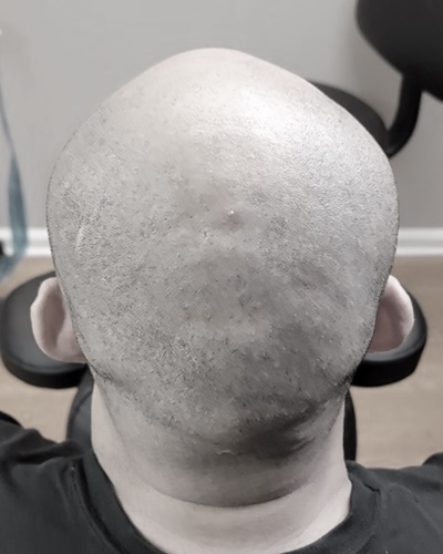 SMP Hair Creations | Scalp Micropigmentation | SMP Hair Tattoo (Before & After)