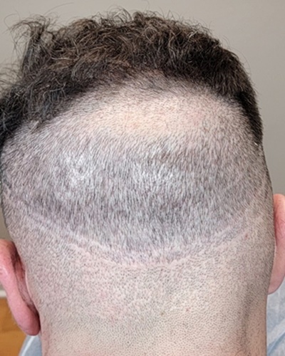 Before back view showing FUT linear scar and FUE thinning pattern on the scalp in Jacksonville FL