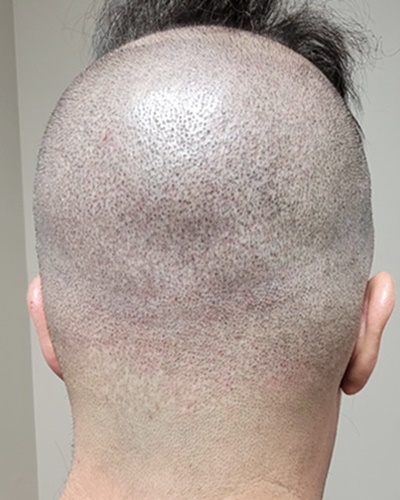 After scalp micropigmentation back view showing FUT scar camouflaged and FUE thinning blended with natural density in Jacksonville FL