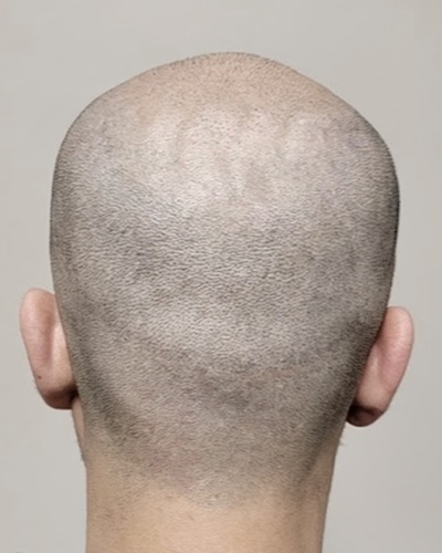 After scar camouflage back view showing linear scar covered with scalp micropigmentation in Jacksonville FL