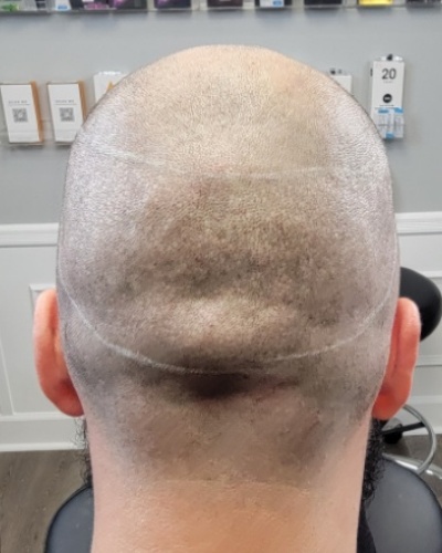 Before back view showing FUE hair transplant scars and uneven scalp appearance in Jacksonville FL