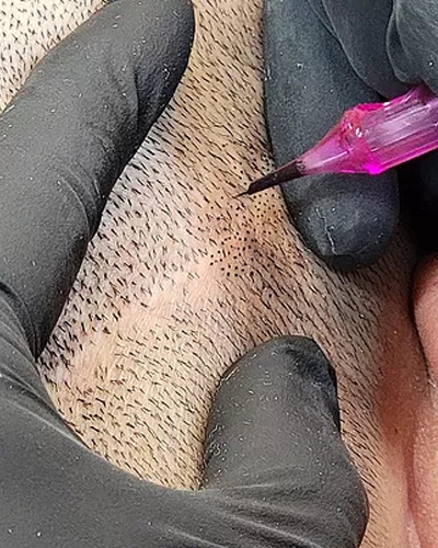 During scalp micropigmentation procedure close-up showing needle applying pigment to create realistic hair follicle dots on the scalp in Jacksonville FL