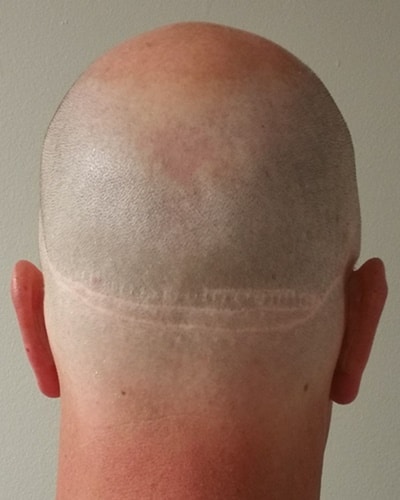 Back view showing FUT linear scar before full scalp micropigmentation blending in Jacksonville FL