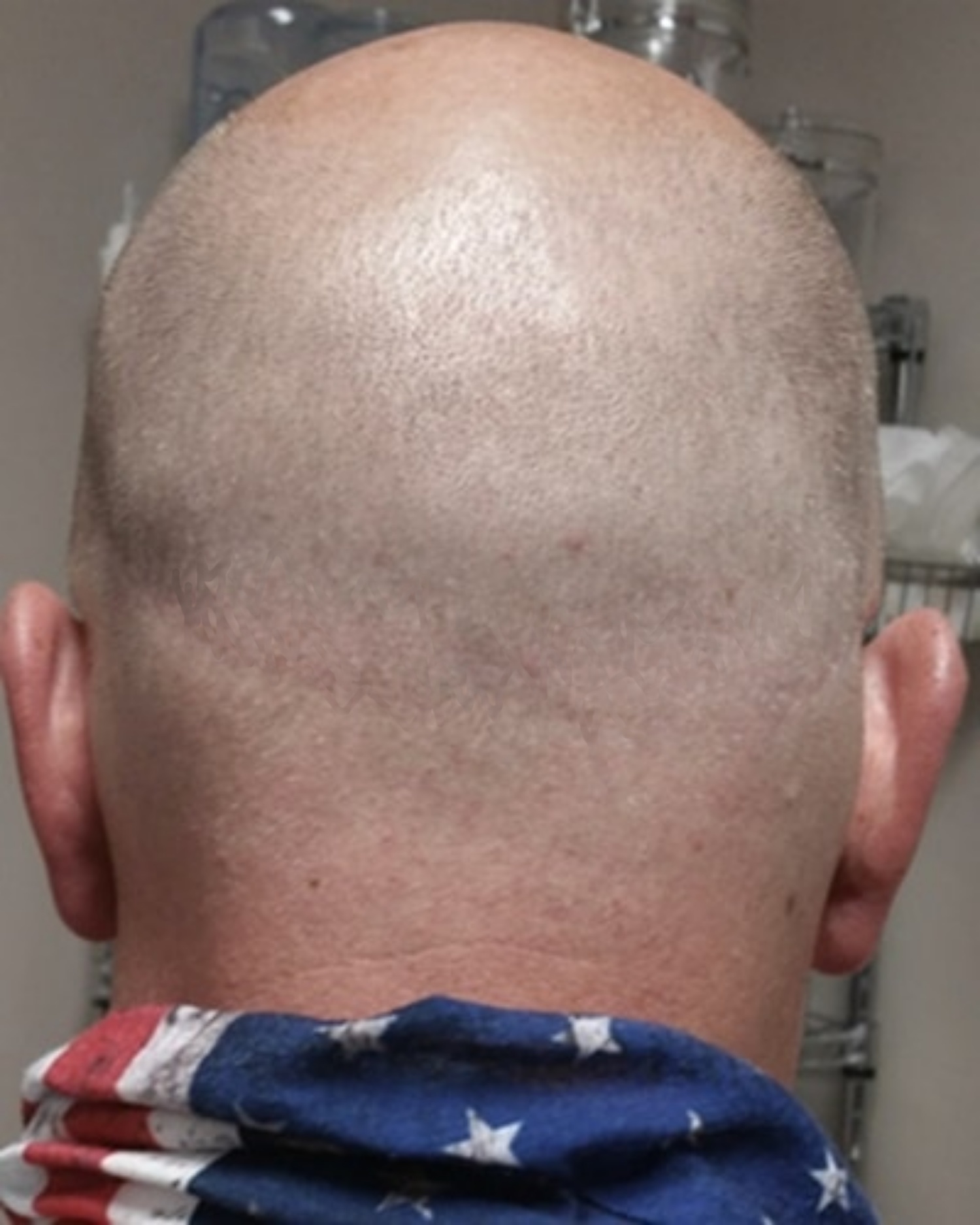 Healed scalp micropigmentation result showing FUT scar fully blended on back of head in Jacksonville FL