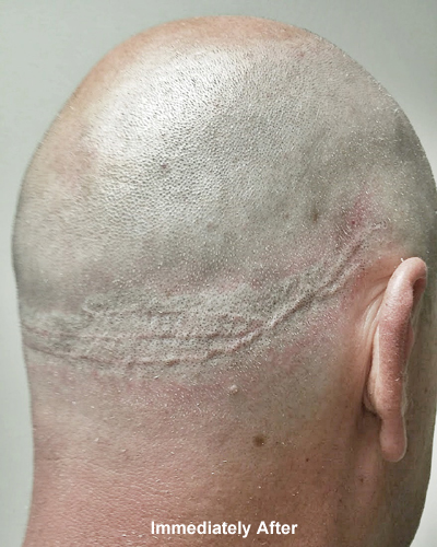 Immediately after scalp micropigmentation showing raised FUT scar with redness and early blending on the back of the head in Jacksonville FL