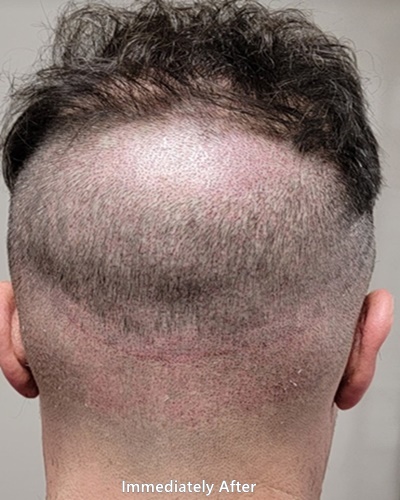 Immediately after scalp micropigmentation back view showing FUT scar camouflage and FUE thinning blending during healing phase in Jacksonville FL